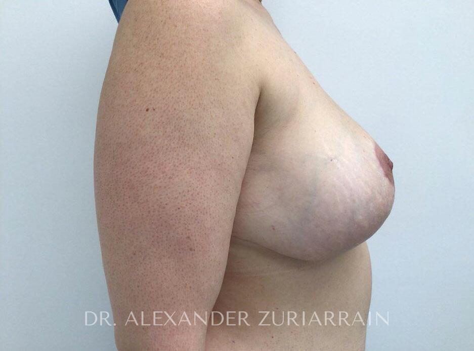 Breast revision before & after photo