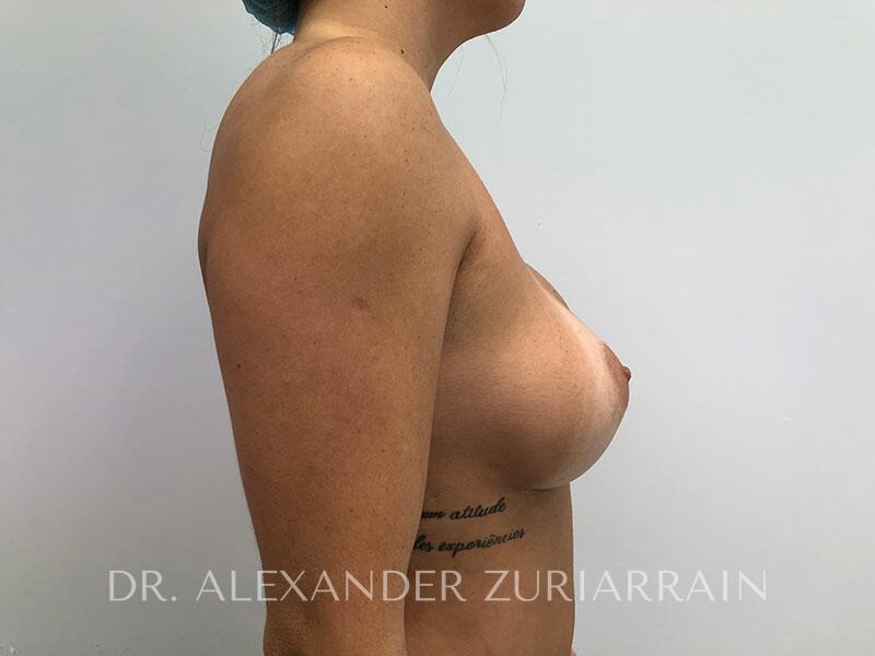 Breast revision before & after photo