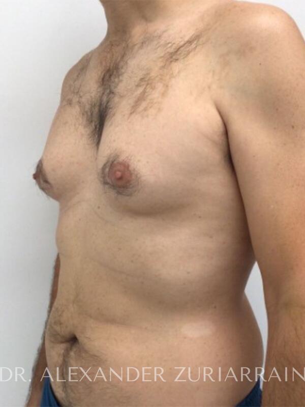 Gynecomastia before & after photo