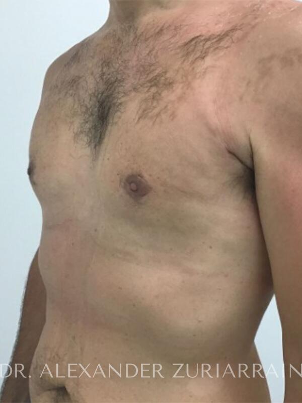 Gynecomastia before & after photo