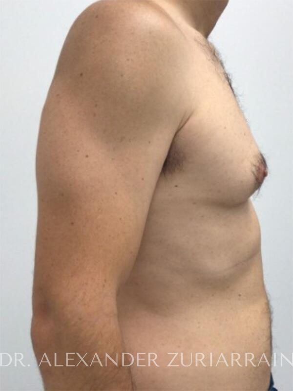 Gynecomastia before & after photo