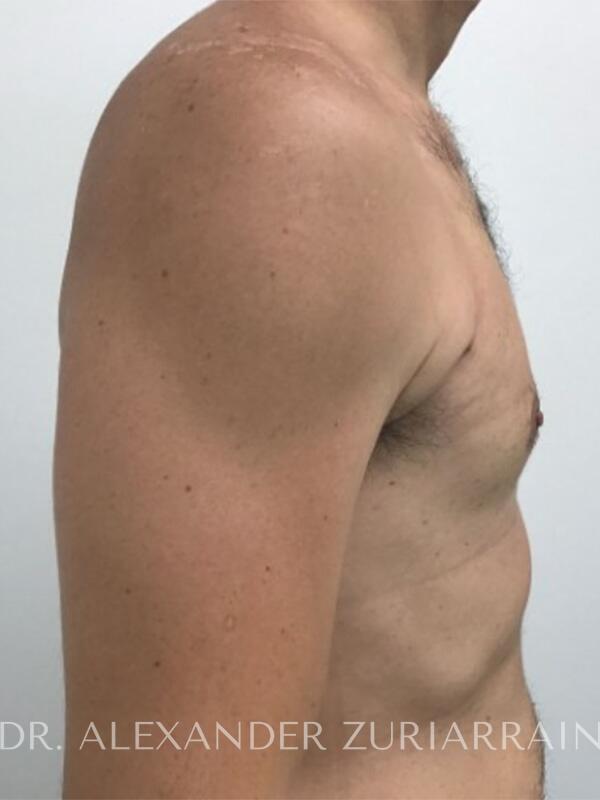 Gynecomastia before & after photo
