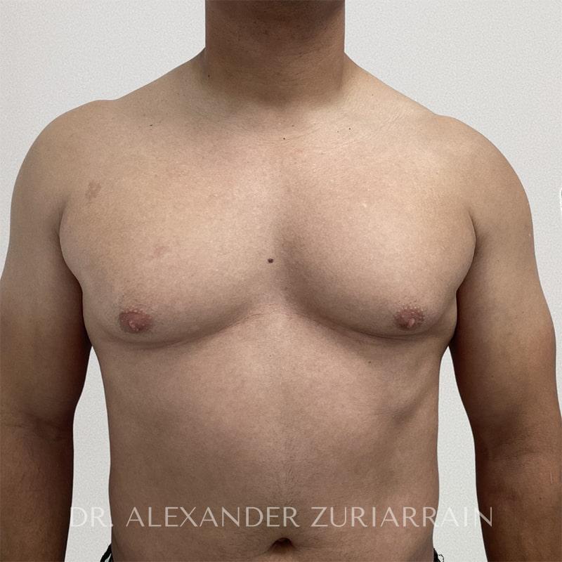 Gynecomastia before & after photo