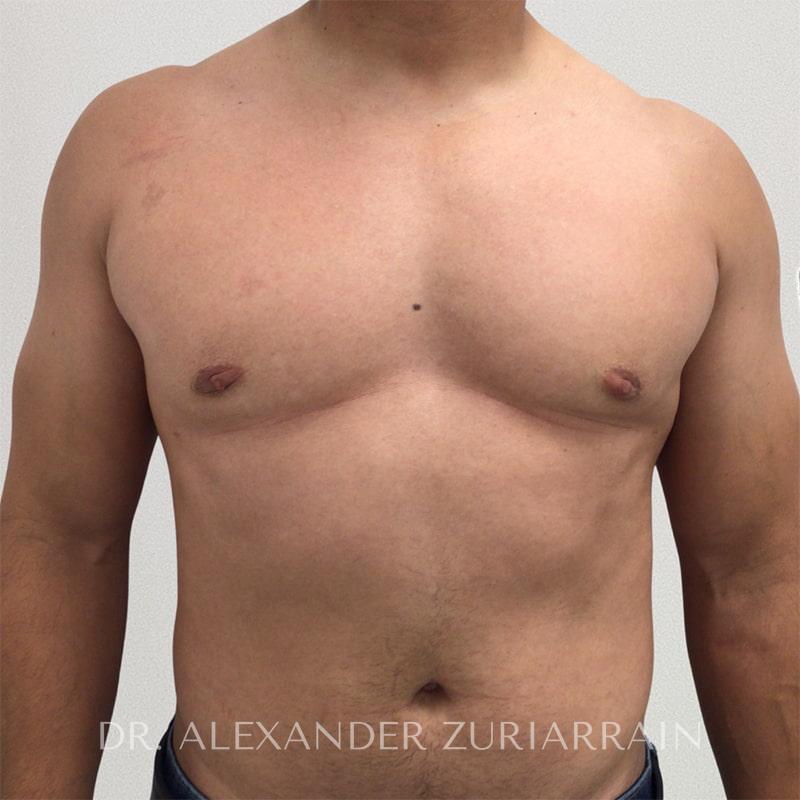 Gynecomastia before & after photo