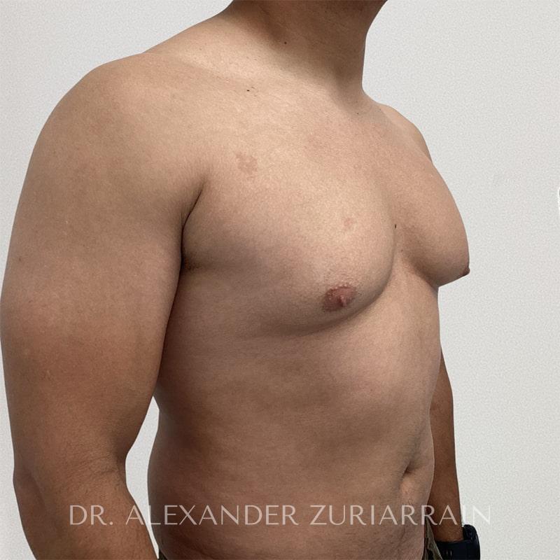 Gynecomastia before & after photo