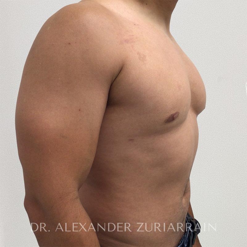 Gynecomastia before & after photo