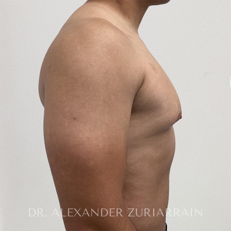 Gynecomastia before & after photo