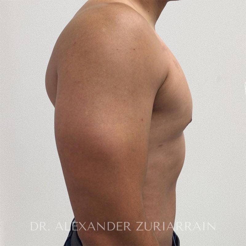 Gynecomastia before & after photo