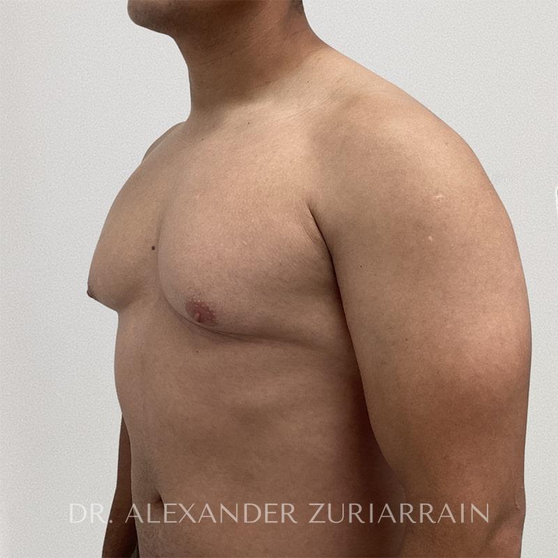 Gynecomastia before & after photo