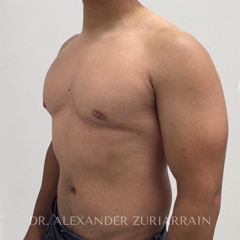 Gynecomastia before & after photo
