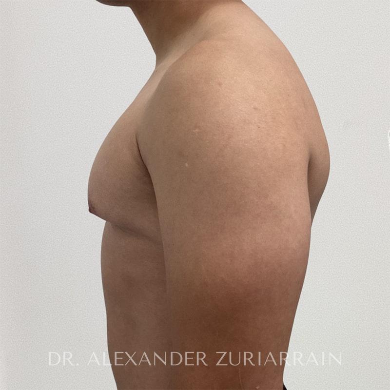 Gynecomastia before & after photo