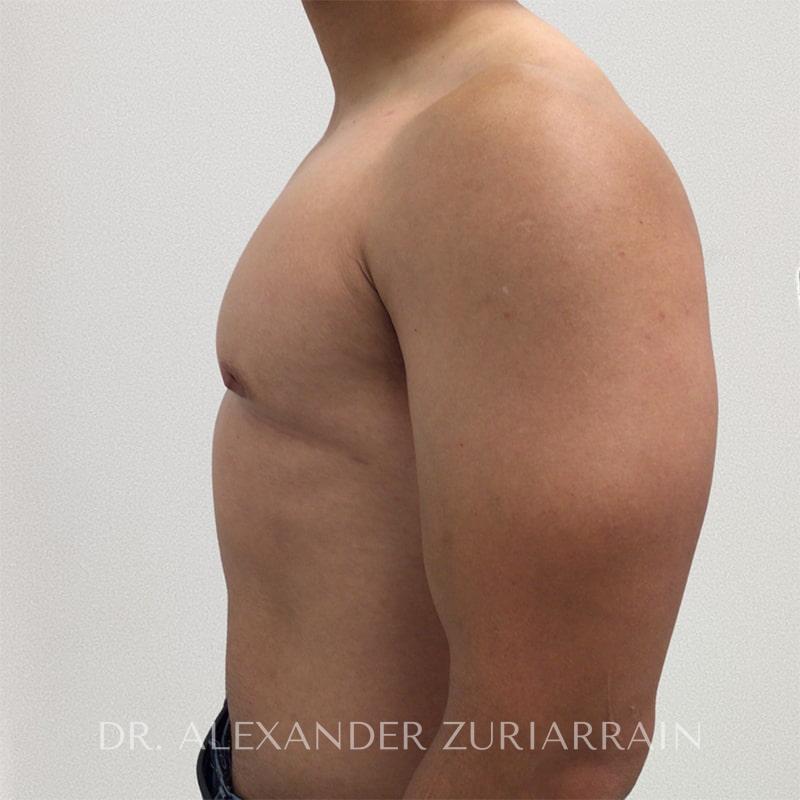 Gynecomastia before & after photo