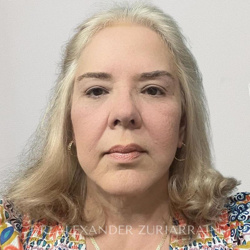 Blepharoplasty before & after photo
