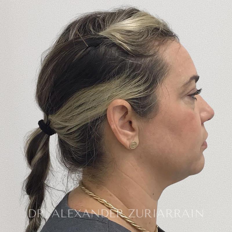 Blepharoplasty before & after photo