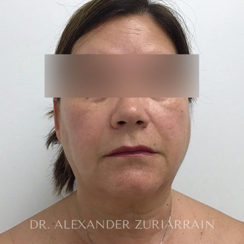 Blepharoplasty before & after photo