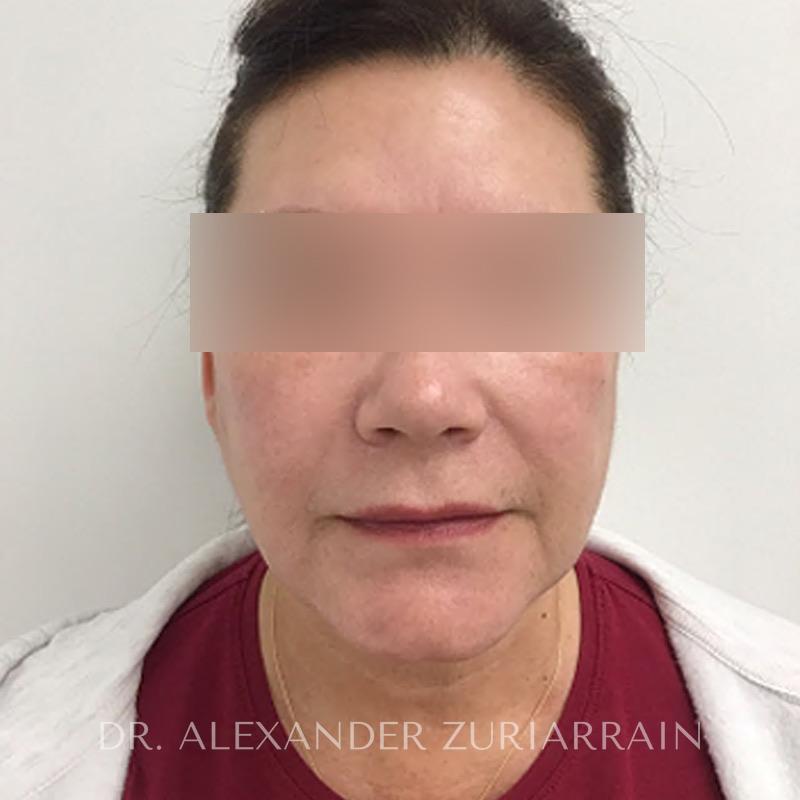 Blepharoplasty before & after photo