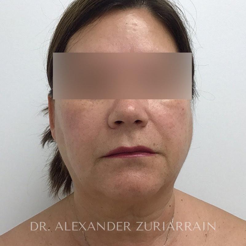 Blepharoplasty before & after photo