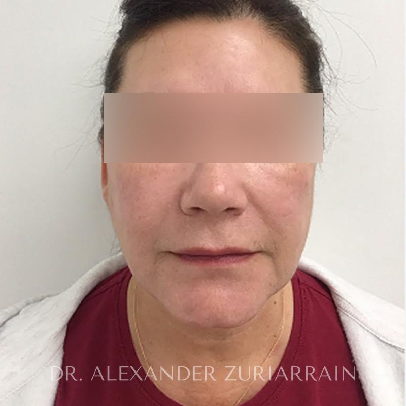 Blepharoplasty before & after photo