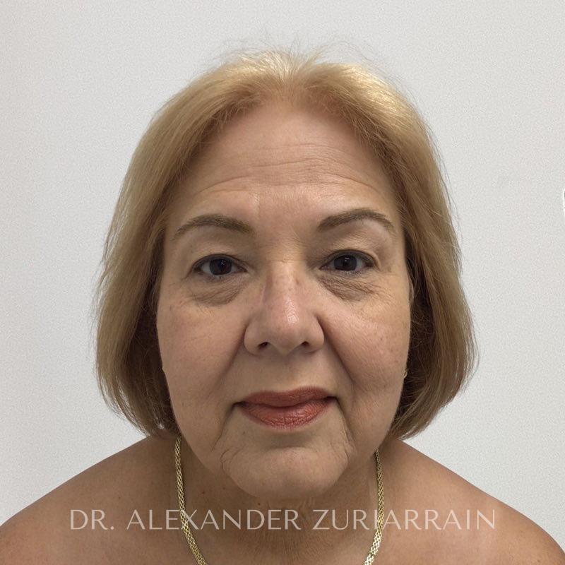 Facelift before & after photo