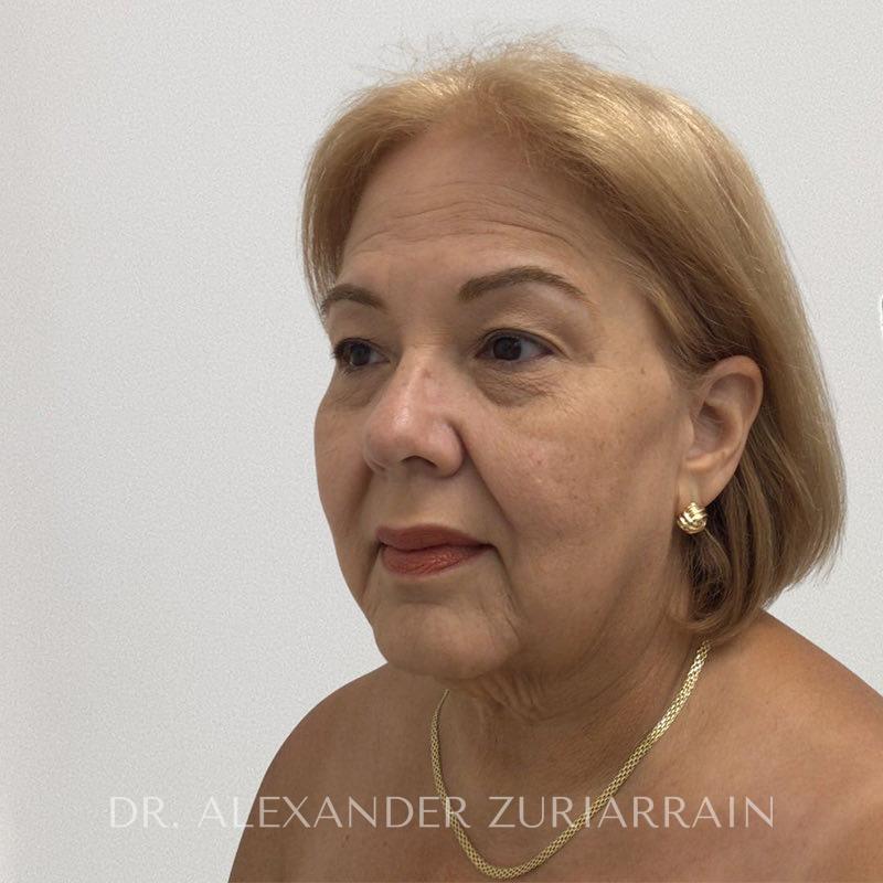 Facelift before & after photo