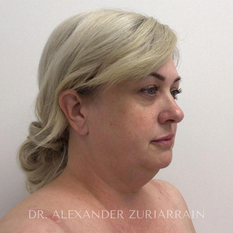 Facelift before & after photo