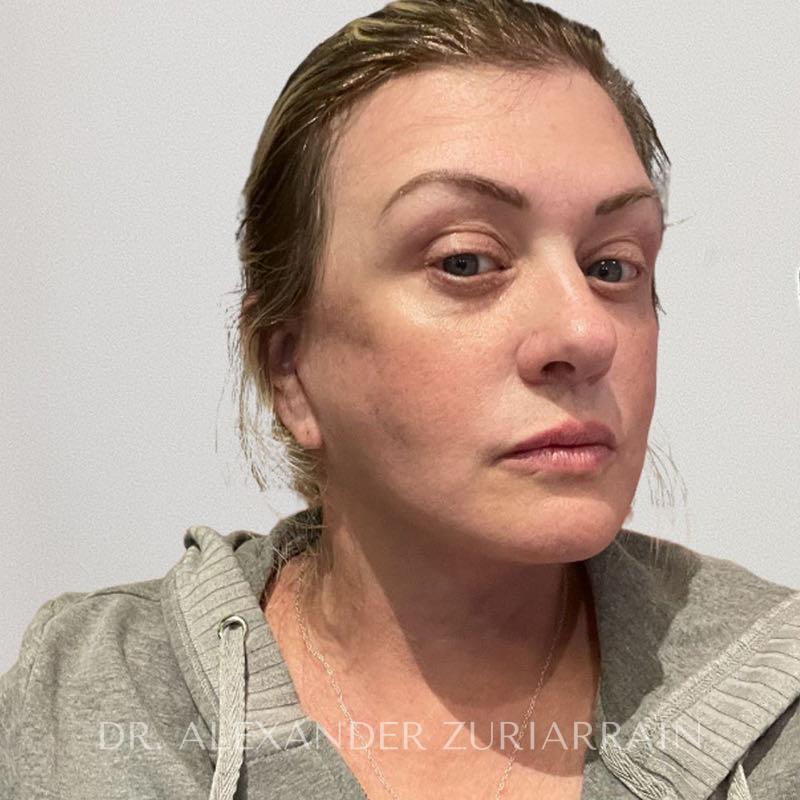 Facelift before & after photo