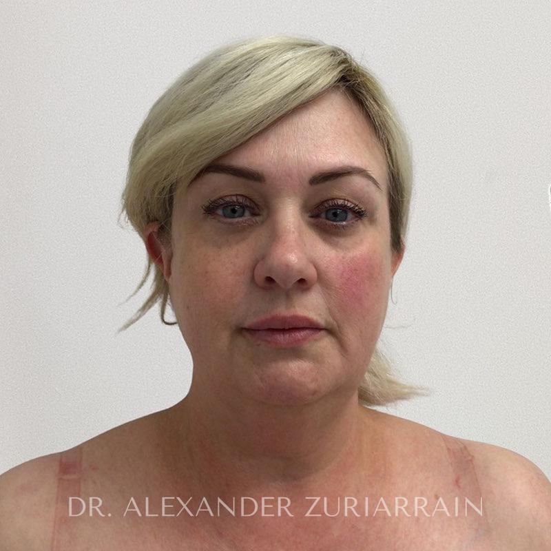 Facelift before & after photo