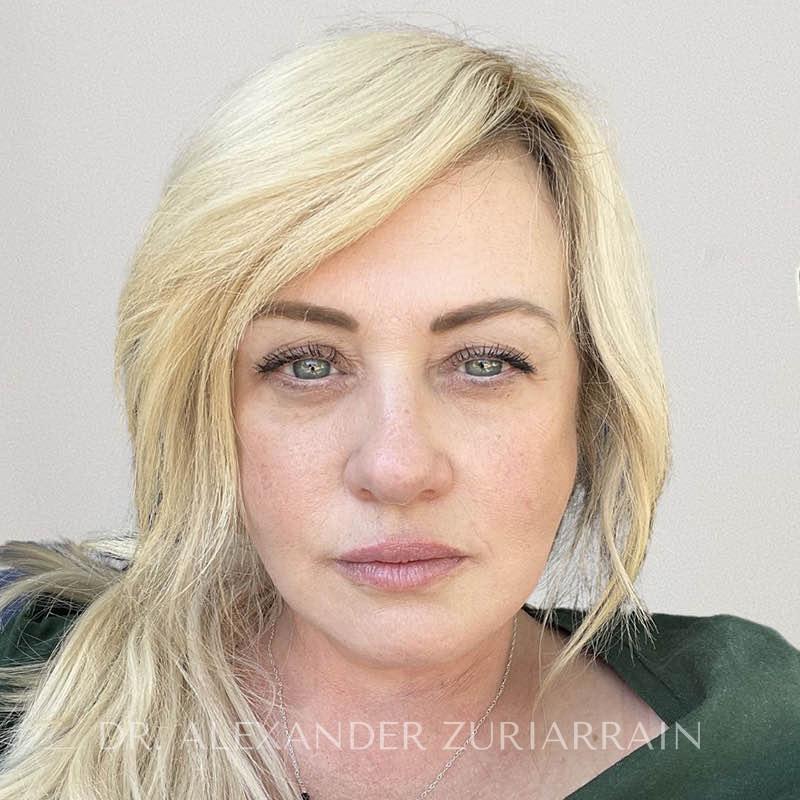 Facelift before & after photo