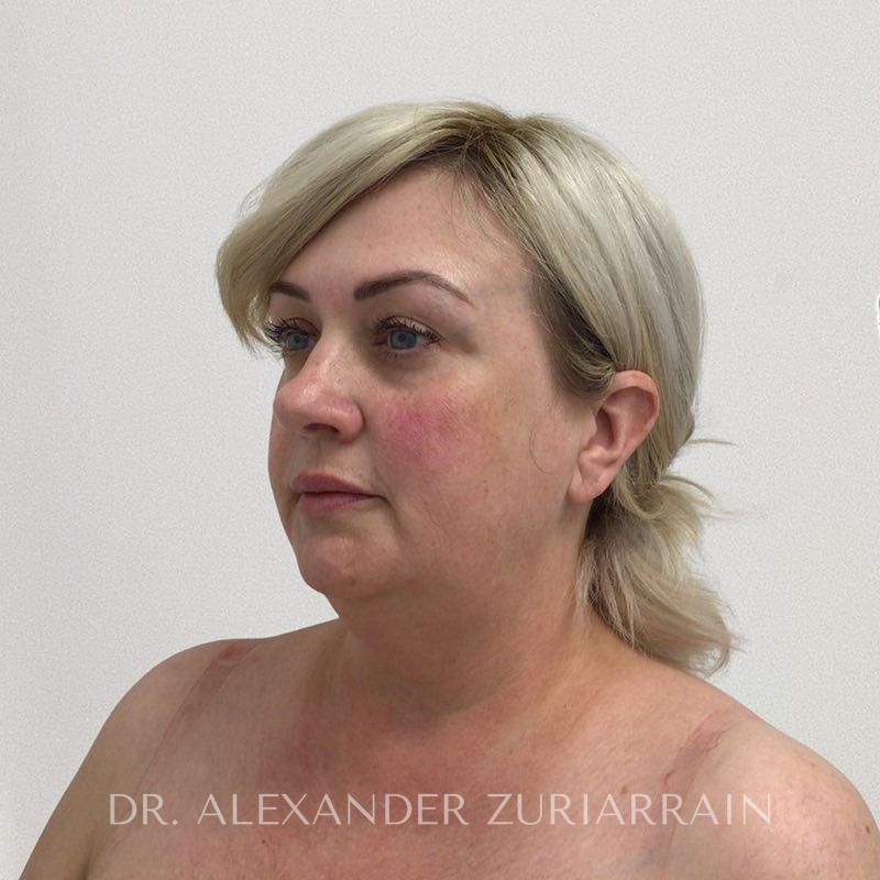 Facelift before & after photo