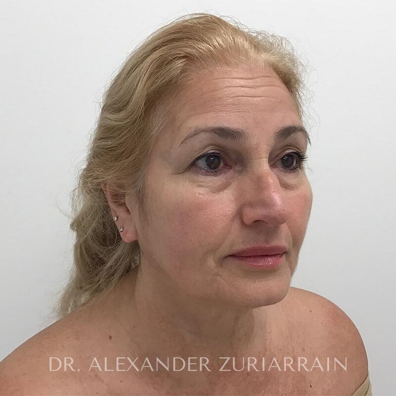 Facelift before & after photo