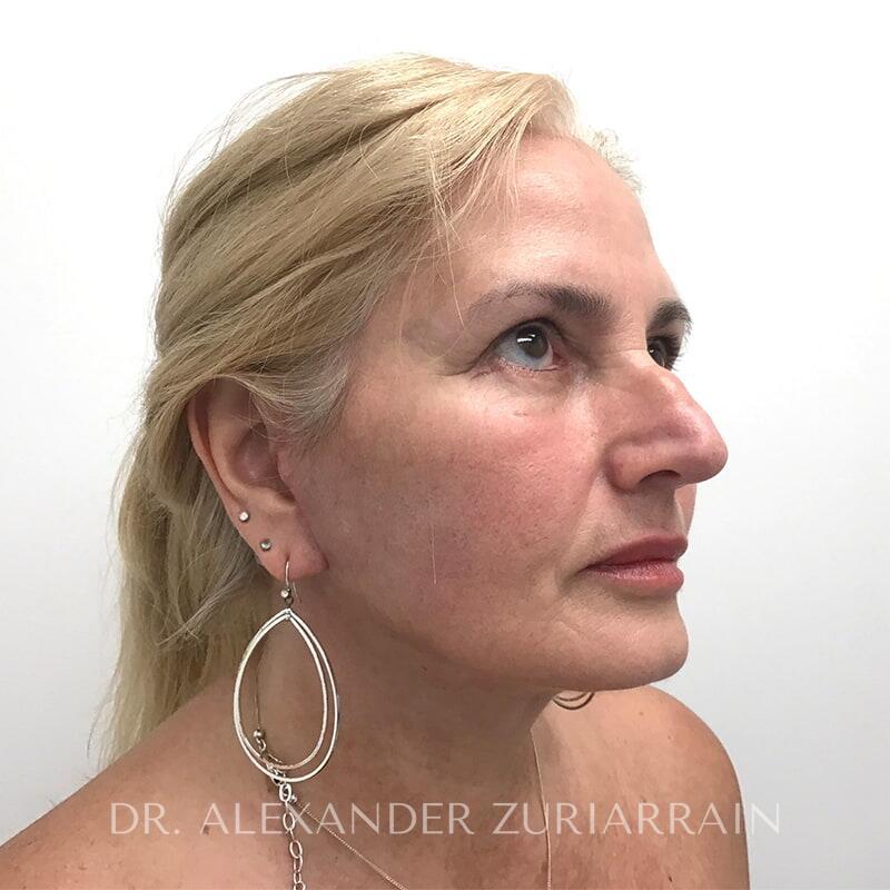 Facelift before & after photo