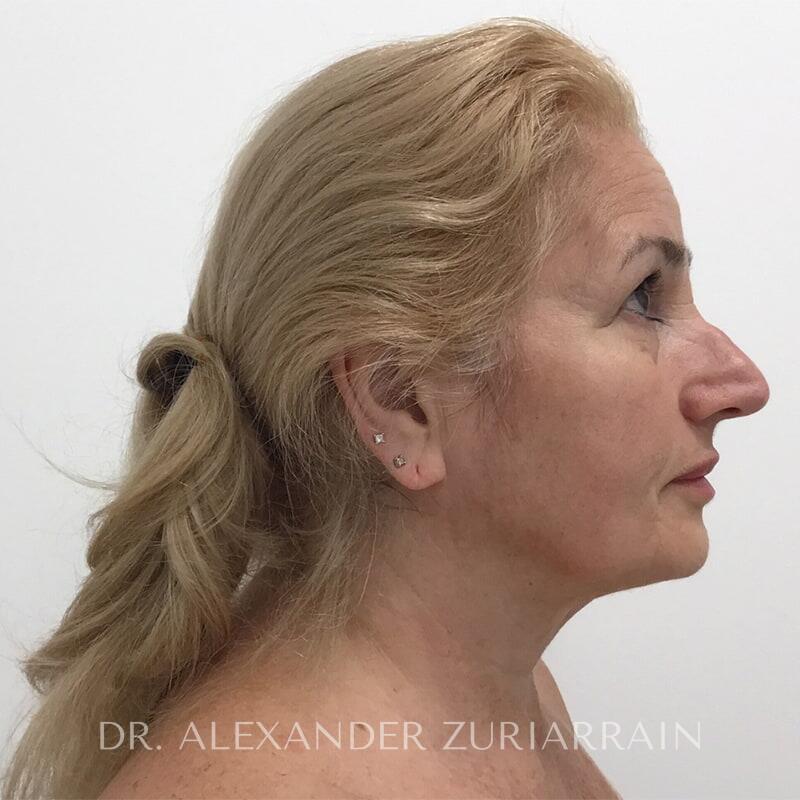 Facelift before & after photo