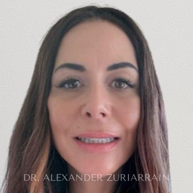 Facelift before & after photo