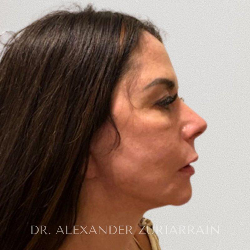 Facelift before & after photo