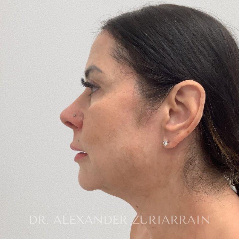 Facelift before & after photo