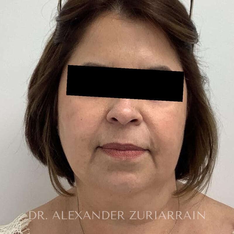 Facelift before & after photo
