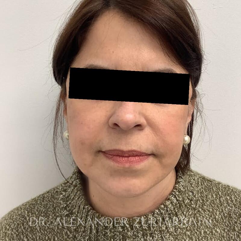 Facelift before & after photo