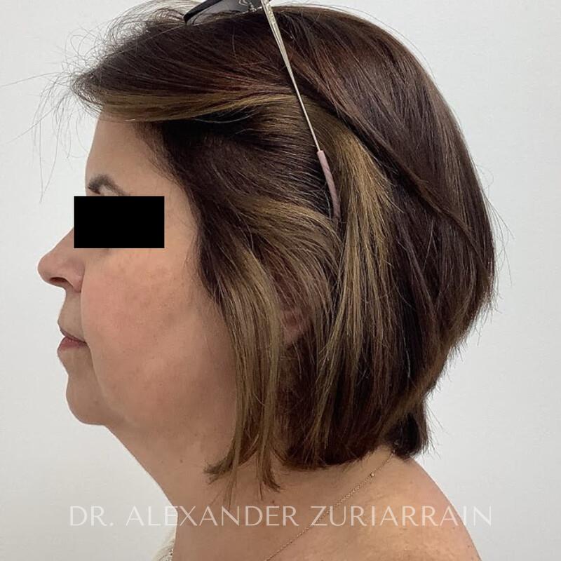 Facelift before & after photo