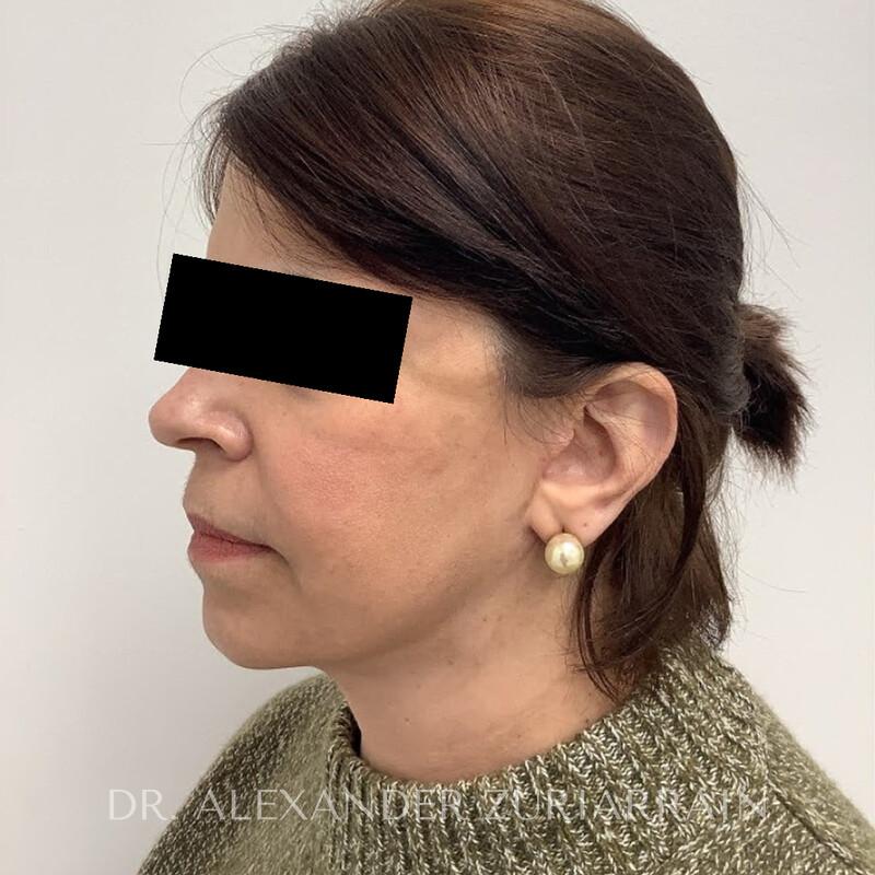 Facelift before & after photo