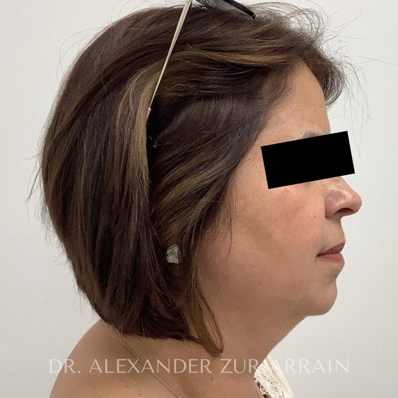 Facelift before & after photo