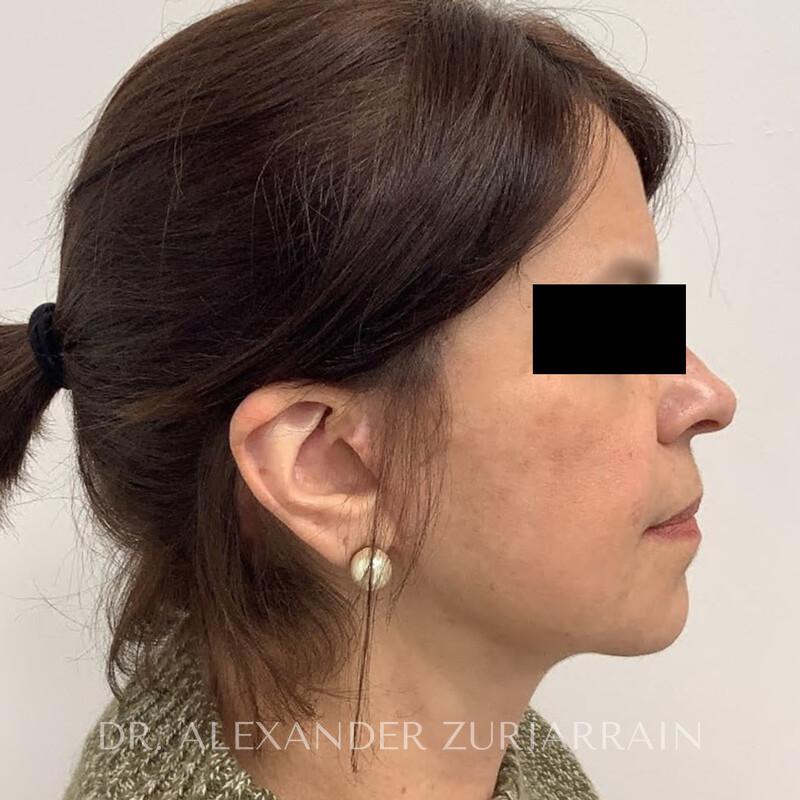 Facelift before & after photo