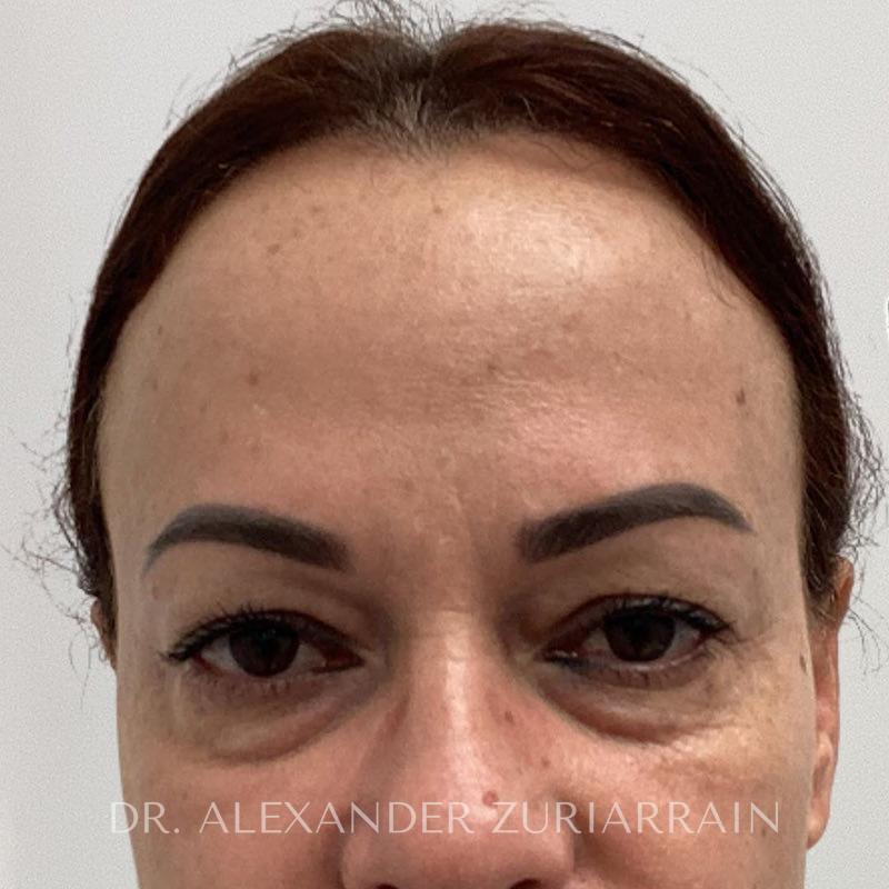 Facial fat grafting before & after photo