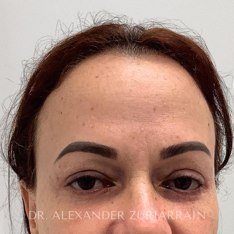 Facial fat grafting before & after photo