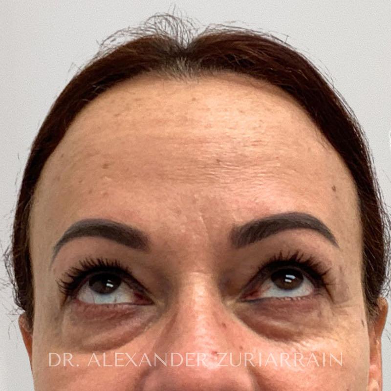 Facial fat grafting before & after photo
