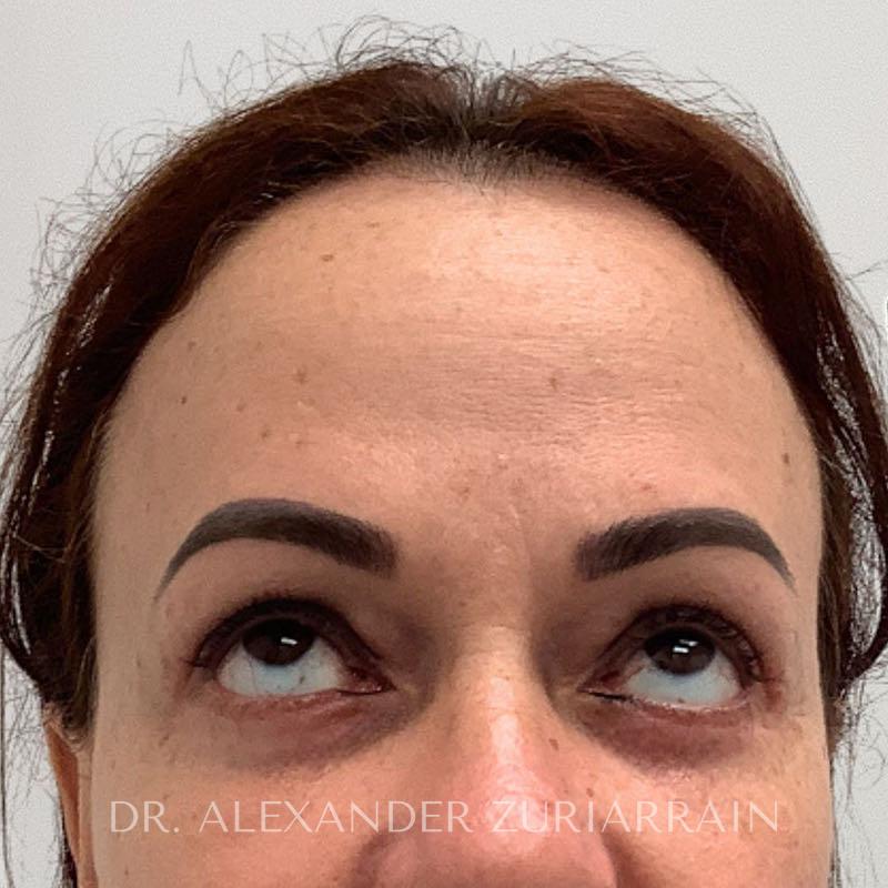 Facial fat grafting before & after photo