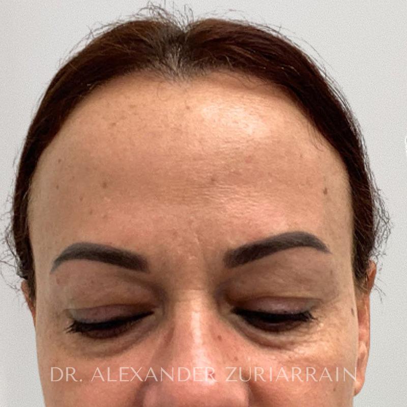Facial fat grafting before & after photo