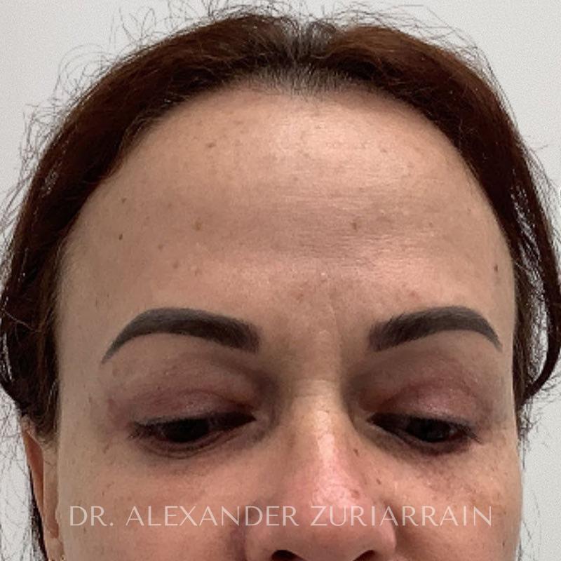 Facial fat grafting before & after photo