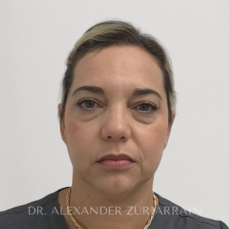 Facial fat grafting before & after photo