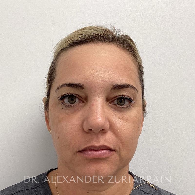 Facial fat grafting before & after photo