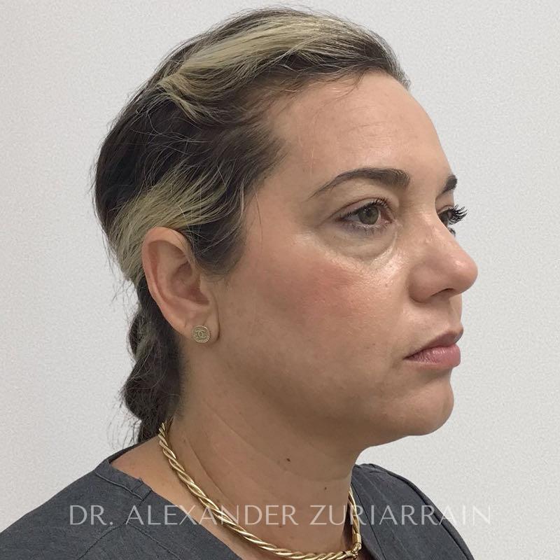Facial fat grafting before & after photo